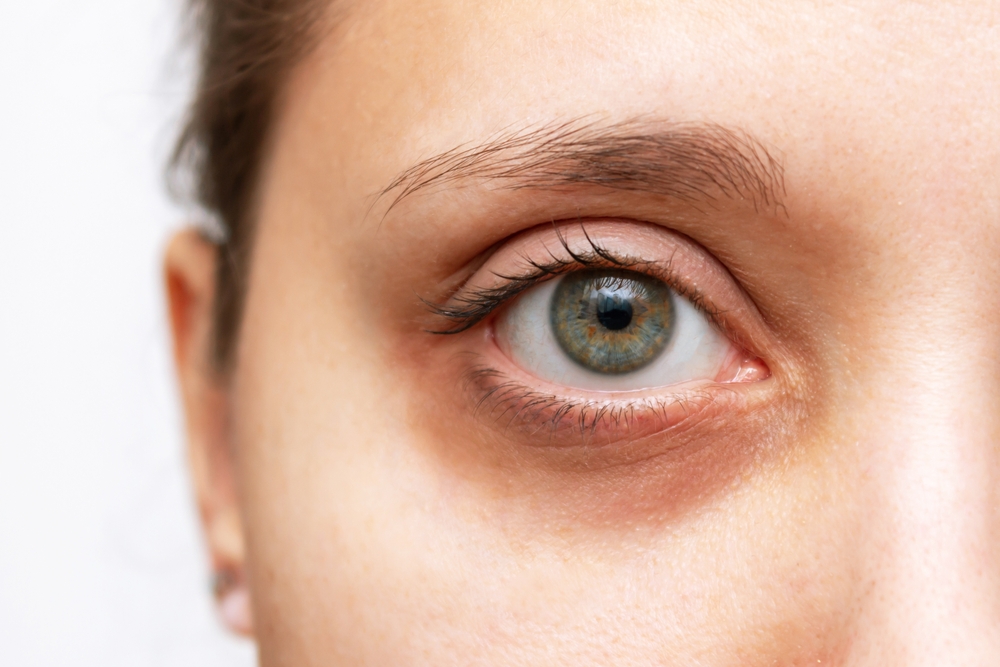 Cropped,Shot,Of,A,Young,Woman's,Face,With,Dark,Circle