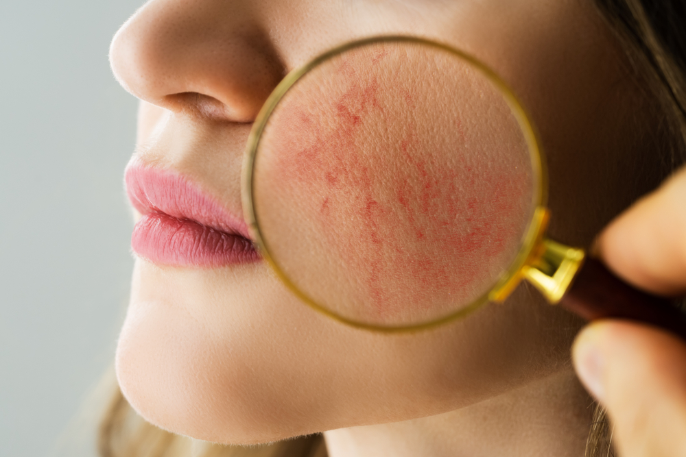 Rosacea,Face,Skin,Problem,And,Aesthetic,Treatment