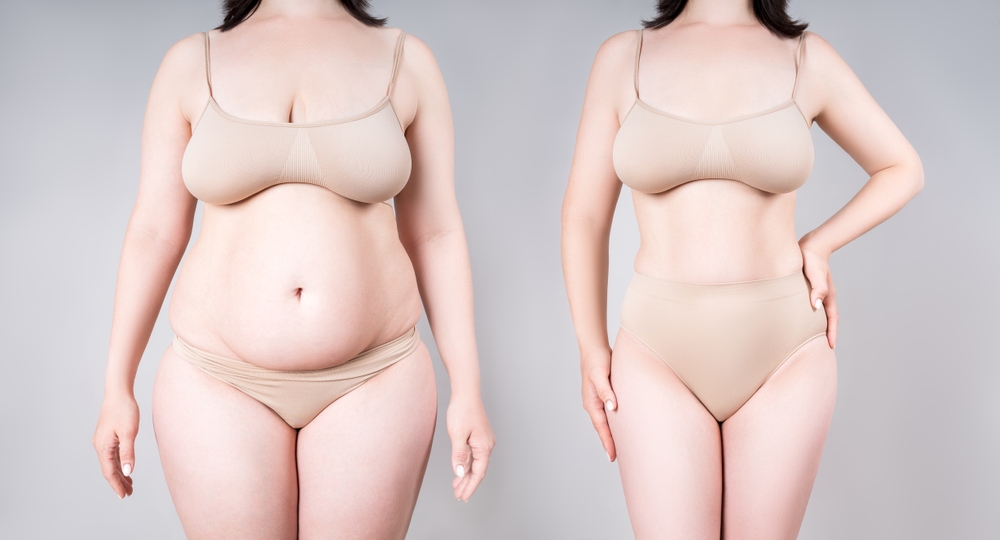 Woman's,Body,Before,And,After,Weight,Loss,Or,Liposuction,On