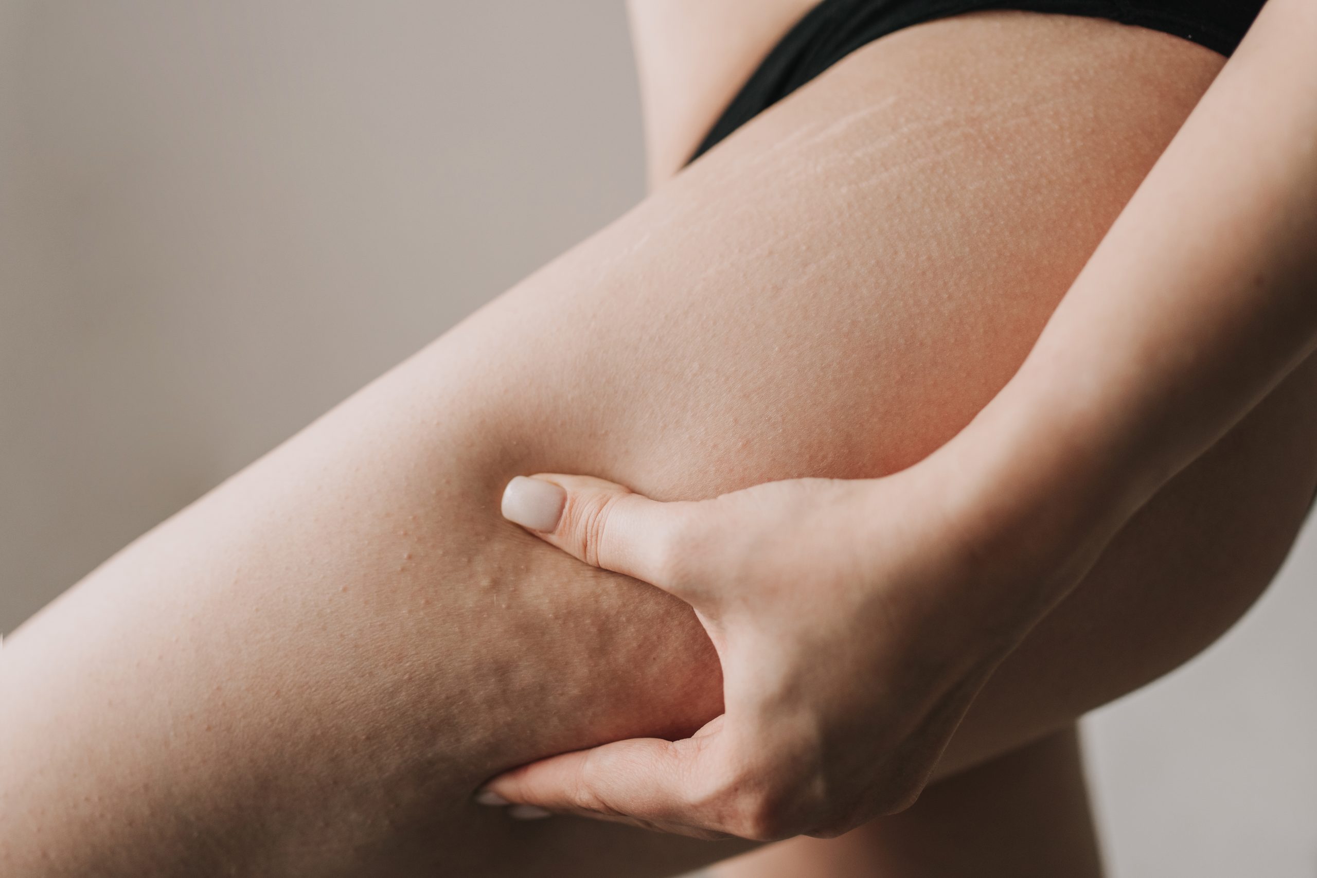 Kollagen kann viel, zum Beispiel Cellulite und Falten bekämpfen.