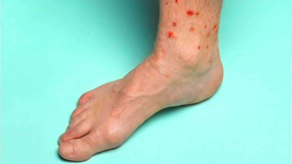 Experten schlagen Alarm: Bettwanzen-Plage erreicht Deutschland