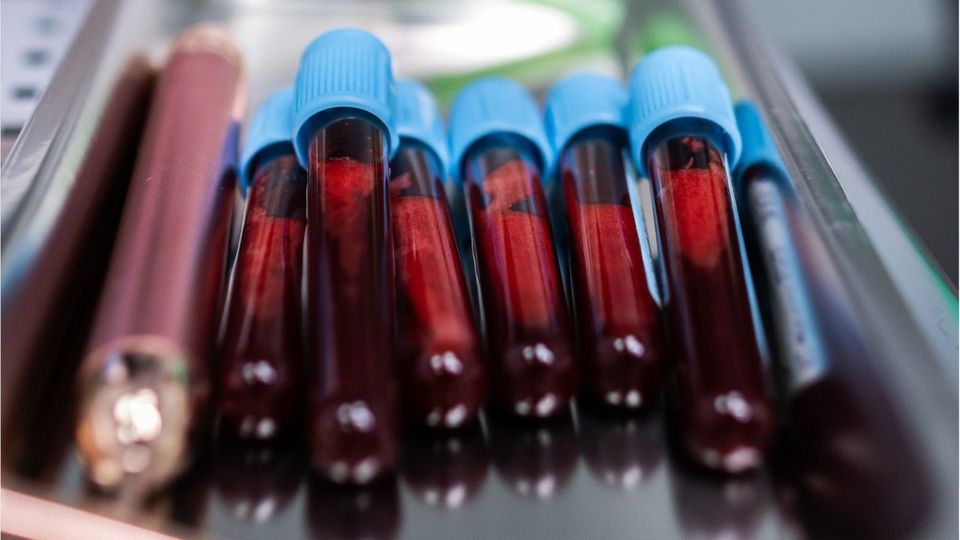 Forschende entdecken Marker für Long Covid im Blut