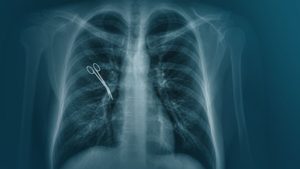 Tausende OP-Behandlungsfehler pro Jahr