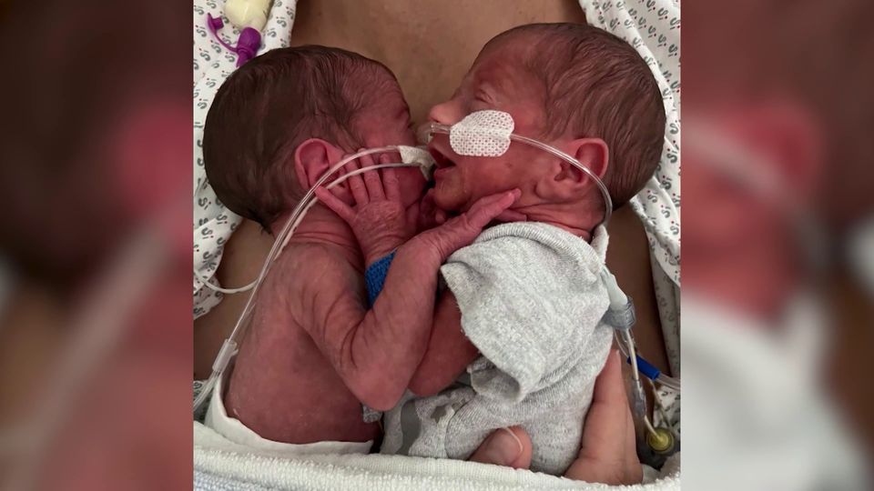 Zwillinge kämpfen nach Frühgeburt in Duisburg