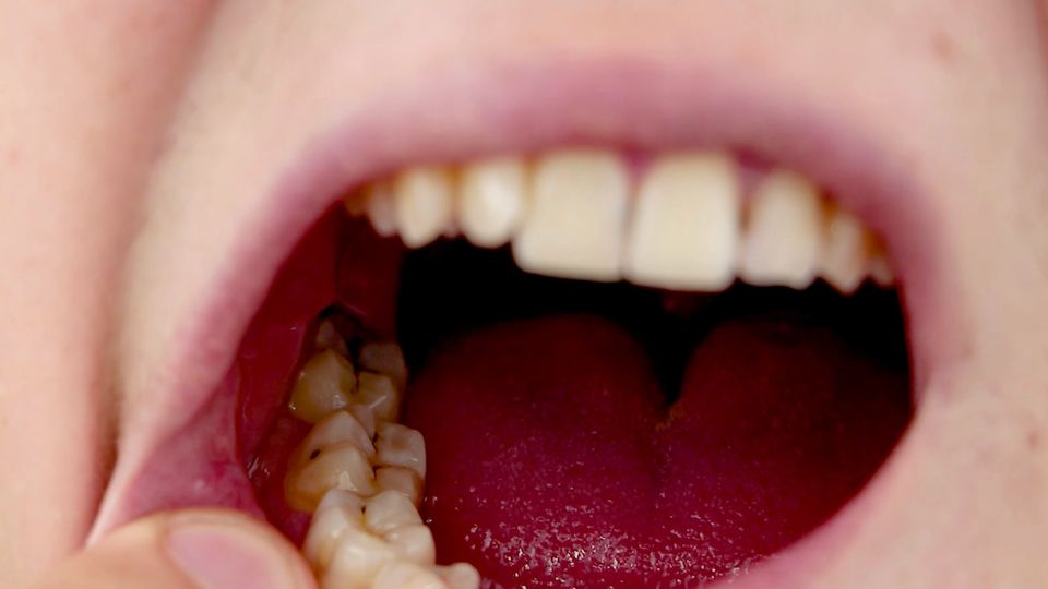 Karies-Bakterium als Ursache für Parkinson?