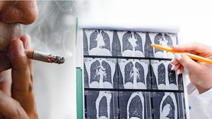 Lungen-Check: Ab April neue Kassenleistung