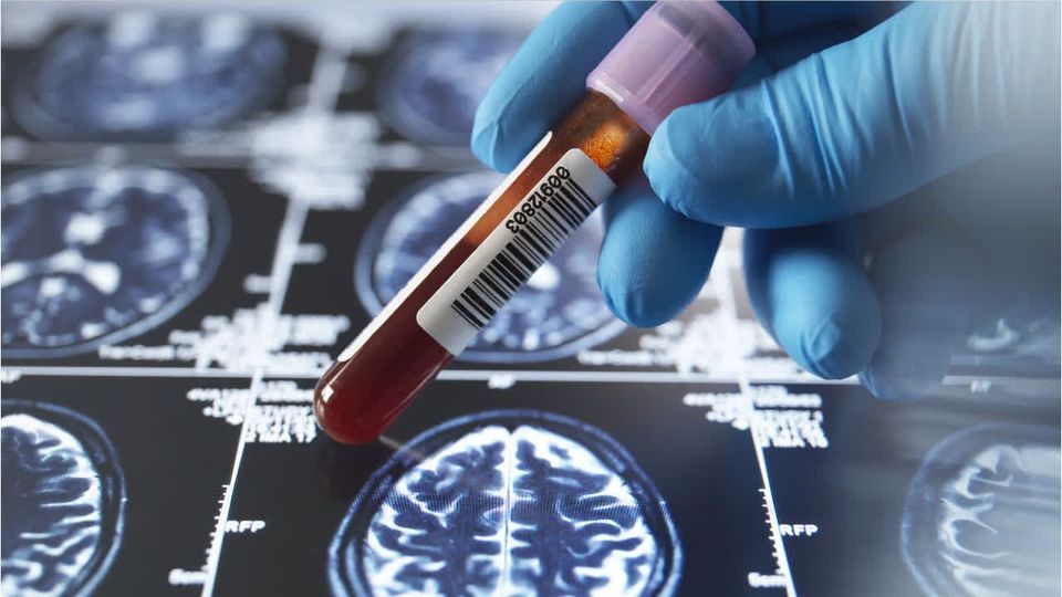 Studie zeigt: Alzheimer verrät sich früher als gedacht